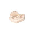 Implant Pagpapanumbalik ng Porcelain Dental Crowns